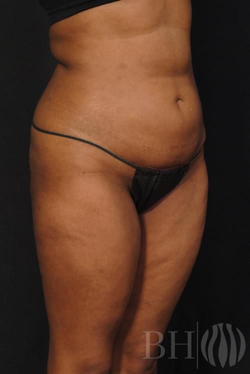 Liposuction Before & After