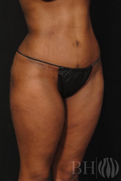 Liposuction Before & After
