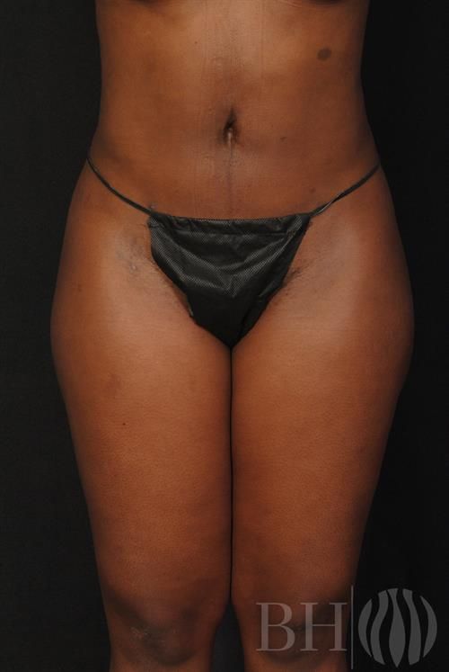 Liposuction Before & After