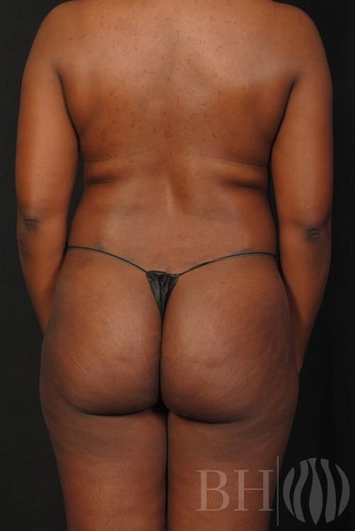 Liposuction Before & After