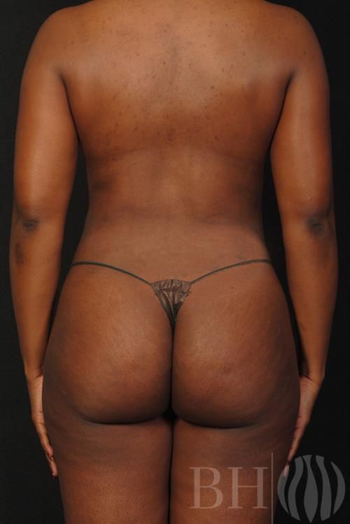 Liposuction Before & After