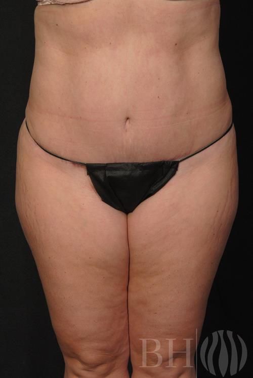 Liposuction Before & After