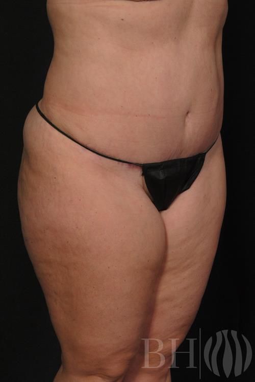 Liposuction Before & After