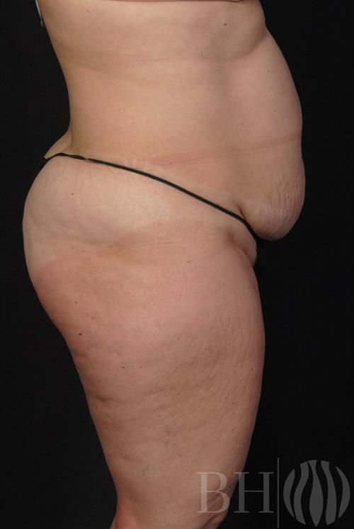 Liposuction Before & After
