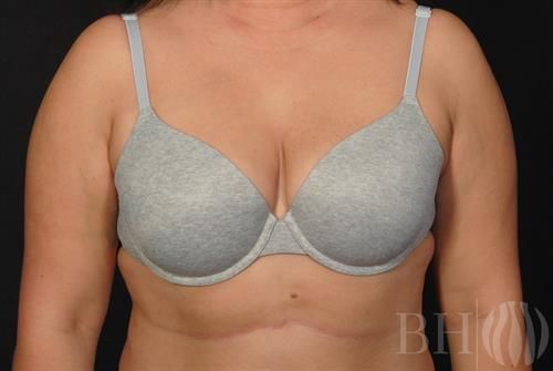 Liposuction Before & After