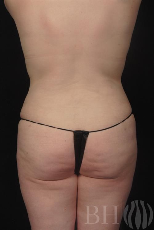 Liposuction Before & After