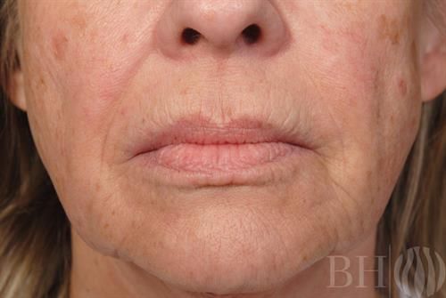 Laser Skin Resurfacing Before & After