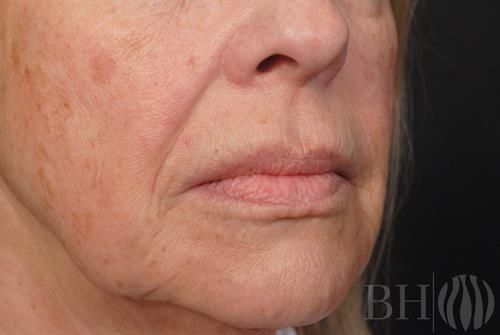 Laser Skin Resurfacing Before & After