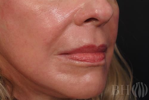 Laser Skin Resurfacing Before & After