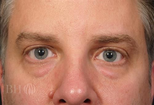 Eyelid Surgery Before & After
