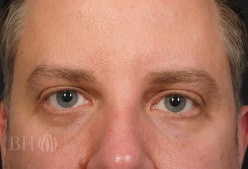 Eyelid Surgery Before & After