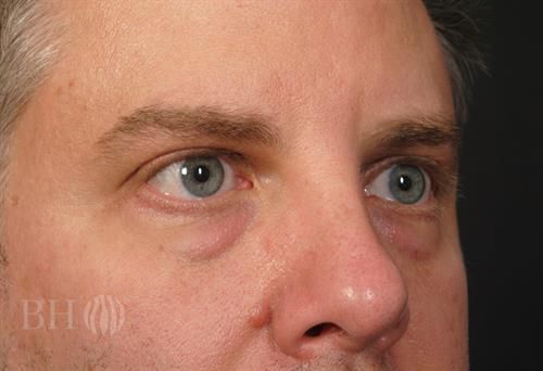 Eyelid Surgery Before & After