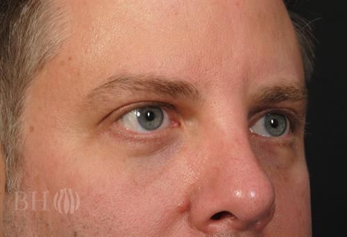 Eyelid Surgery Before & After