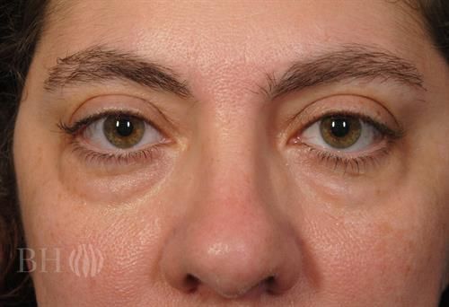 Eyelid Surgery Before & After