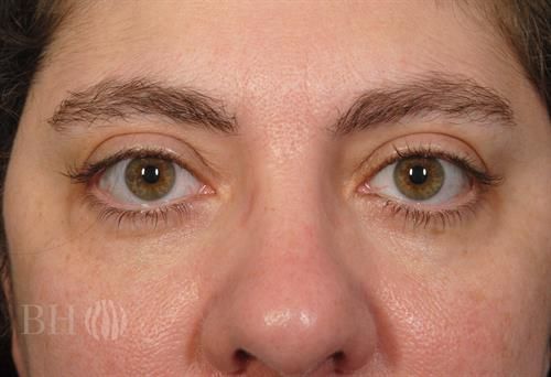 Eyelid Surgery Before & After