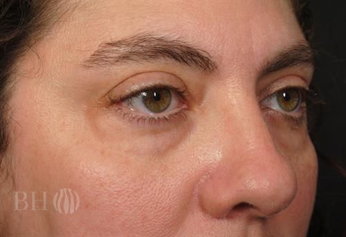 Eyelid Surgery Before & After