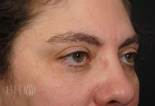 Eyelid Surgery Before & After