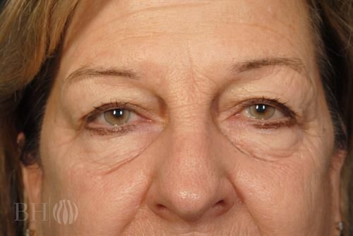 Eyelid Surgery Before & After