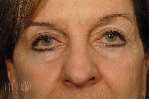 Eyelid Surgery Before & After