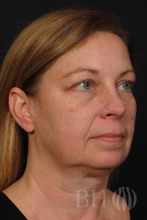 Eyelid Surgery Before & After