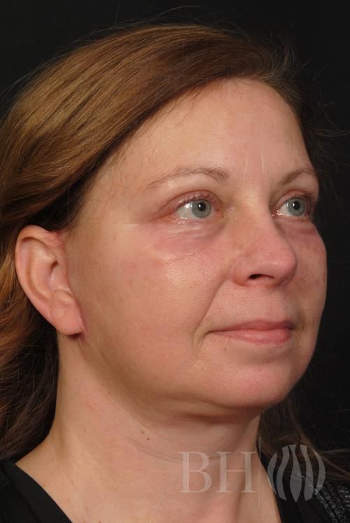 Eyelid Surgery Before & After