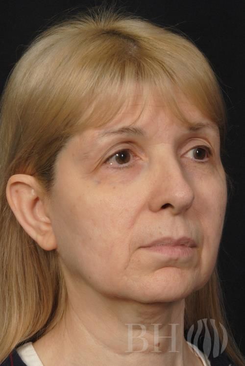 Eyelid Surgery Before & After