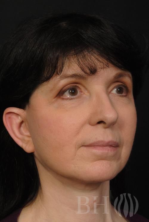 Eyelid Surgery Before & After