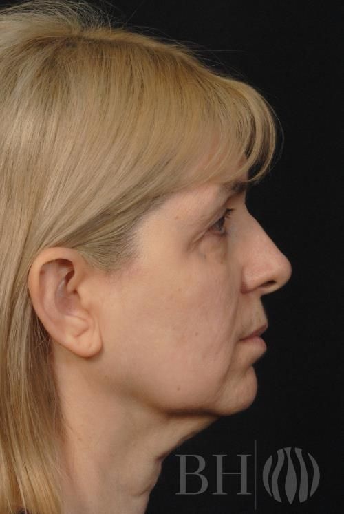 Eyelid Surgery Before & After