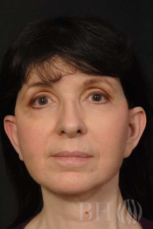 Eyelid Surgery Before & After