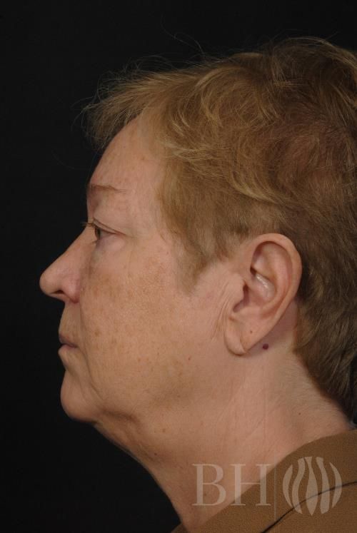 Eyelid Surgery Before & After