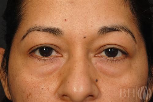 Eyelid Surgery Before & After