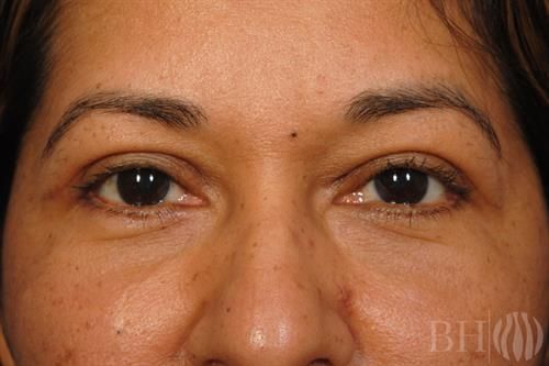 Eyelid Surgery Before & After