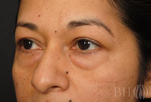 Eyelid Surgery Before & After