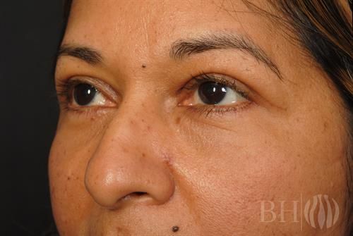 Eyelid Surgery Before & After