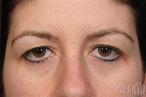 Eyelid Surgery Before & After