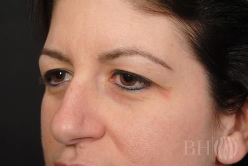 Eyelid Surgery Before & After