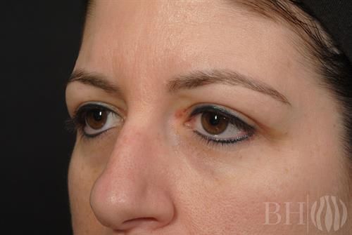 Eyelid Surgery Before & After