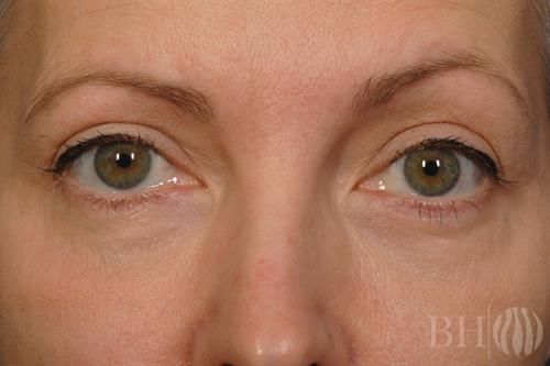 Eyelid Surgery Before & After