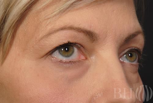 Eyelid Surgery Before & After