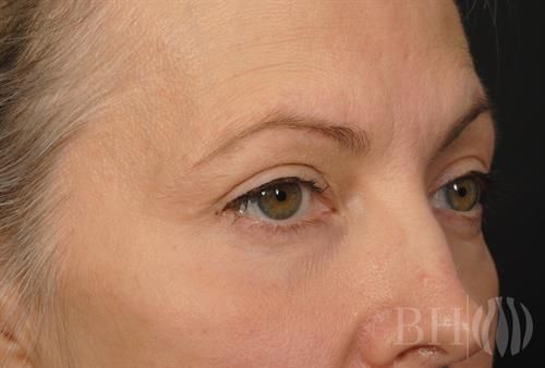 Eyelid Surgery Before & After