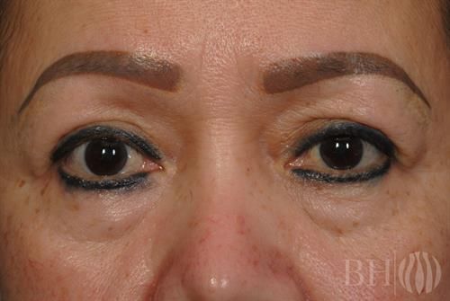 Eyelid Surgery Before & After