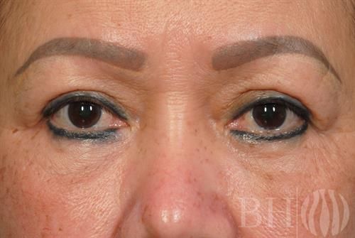 Eyelid Surgery Before & After