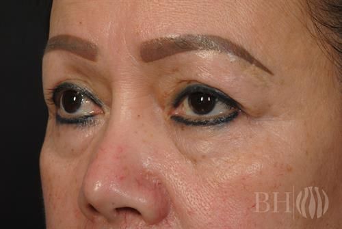 Eyelid Surgery Before & After