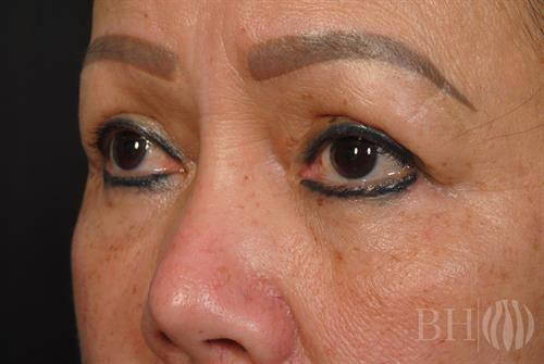 Eyelid Surgery Before & After