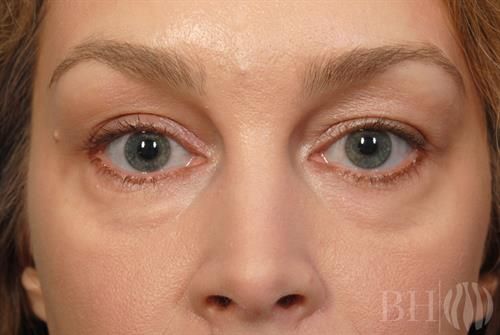 Eyelid Surgery Before & After