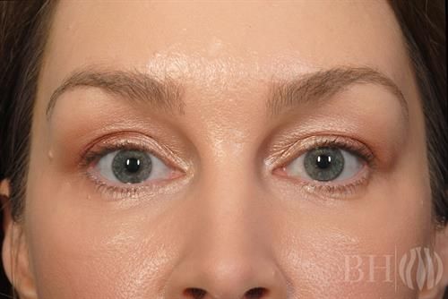 Eyelid Surgery Before & After
