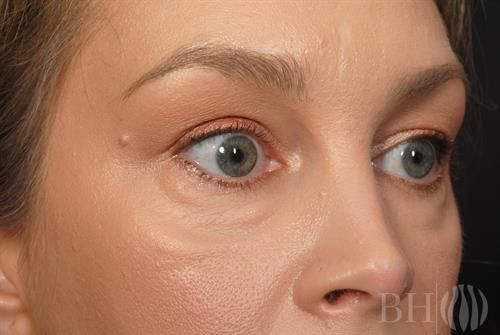 Eyelid Surgery Before & After