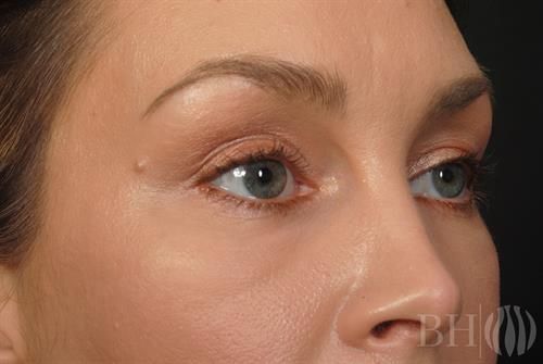 Eyelid Surgery Before & After