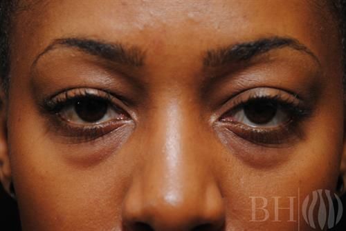 Eyelid Surgery Before & After