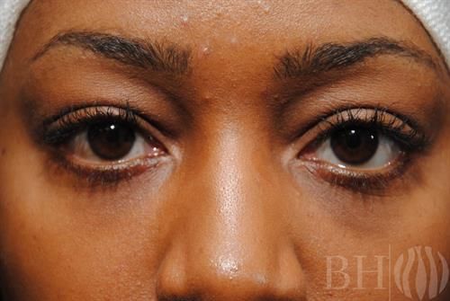 Eyelid Surgery Before & After
